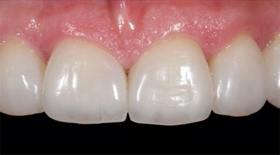 بعد تجميل الاسنان والحشوات التجميل 4